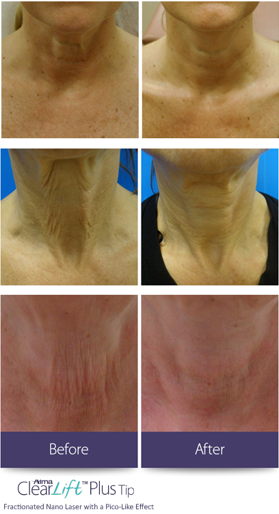 beforeandafter-clearlift.png